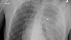 Doctor’s Startling Reminder: Guns Top Cause of Child and Teen Deaths